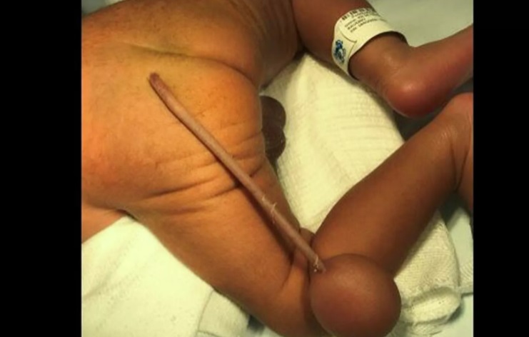 A baby was born having a tail of 12 cm! [VIDEO]